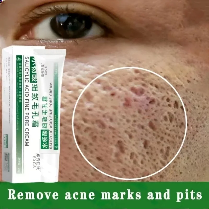 Krem z kwasem salicylowym do o – Salicylic Acid Blackhead Remover recenzja i cena
