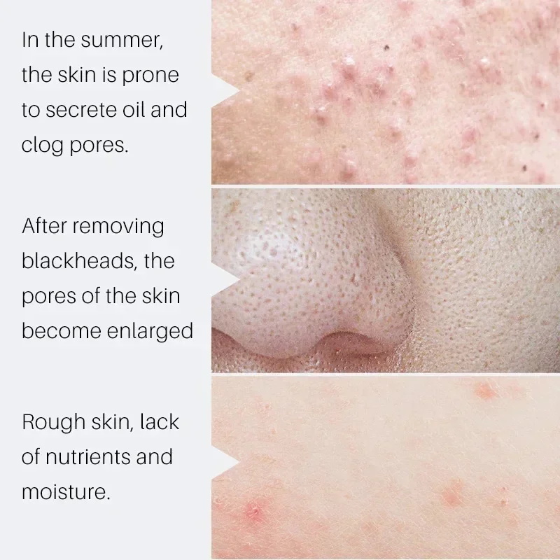 Serum z kwasem salicylowym zwę – Salicylic Acid Blackhead Remover recenzja i cena